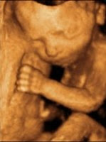 Ultrasonla cinsiyet ne zaman anlaşılabilir?