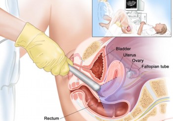 Transvajinal Ultrason